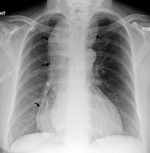 A CXR showing achalasia ( arrows point to the ...