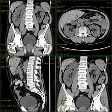 CT scan showing autosomal dominant polycystic kidney disease Adpkd.jpg