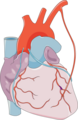 Coronary Artery Bypass Grafting 1