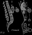 Fig. 82. Schéma (profil) de la suspension du côlon transverse à l'estomac Cinq coupes antéro-postérieures suivant cinq plans verticaux successifs et parallèles dont le premier passe un peu à droite du pylore, le dernier au niveau de la grosse tubérosité de l'estomac. — E, estomac; C, côlon; D, duodénum; I, iléon; Ac, arrière-­cavité de l'épiploon; Gc, épiploon gastro-colique; W, hiatus de Winslow. 1. Le plan passe au ni veau du duodénum à sa naissance. — II. Au niveau de la portion prépylorique de la grande courbure, le poids. montre que le côlon (c') est suspendu à l'estomac (E). — II' Mct, mésocôlon transverse (doctrine de Meckel. Müller); les 4 feuillets étant soudés en Mct, le résultat est le même. (F. Glénard. De l'entéroptose Lyon médical 1885).