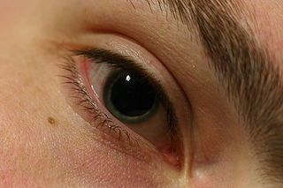 Dilated pupil.gk.jpg