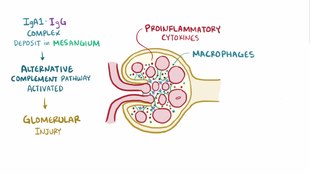 ملف:IgA Nephropathy.webm