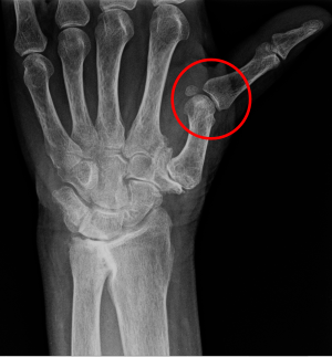 Metacarpophalangeal subluxation.svg