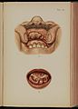 Tab 41, Infiltration, submucosa, mouth. Mracek 1898 Wellcome L0074258.jpg