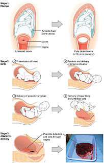 Vaginal delivery Delivery through the vagina