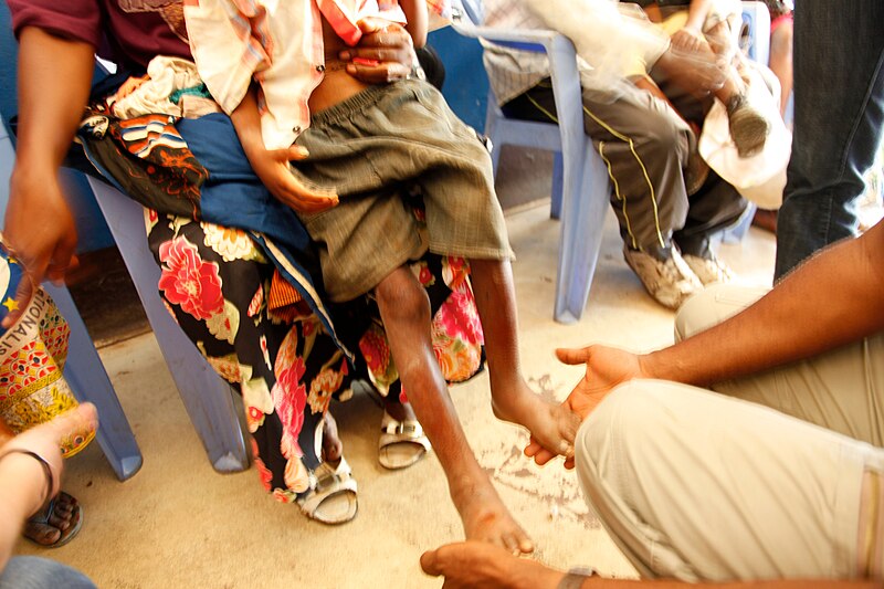 File:A boy is checked for signs of malnutrition in the local hospital, Masi Manimba, DRC (7610158306).jpg