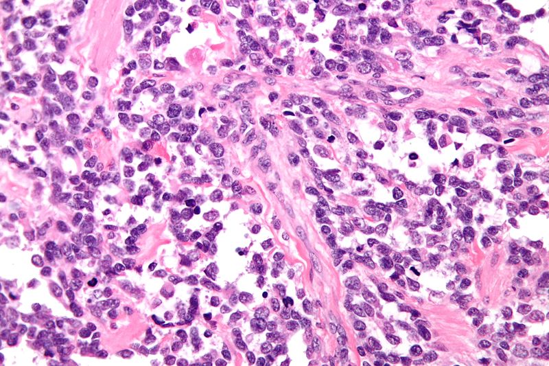 File:Alveolar rhabdomyosarcoma - very high mag.jpg