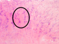 Antoni A area of schwannoma with Verocay bodies (one annotated by circle)