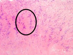 Antoni A area of schwannoma with Verocay bodies (one annotated by circle).