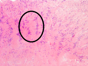 Antoni A area of schwannoma with Verocay bodies - annotated.png