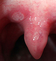 herpes sur la langue