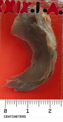 Photograph of a congenital discoid menisci specimen from the University of Cape Town Pathology Learning Centre teaching collection. CONGENITAL DISCOID MENISCI.jpg