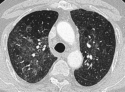 High-Resolution CT image in a patient with Pneumocystis pneumonia infection showing ground-glass opacities. CT of infiltrates of pneumocystis pneumonia.jpg