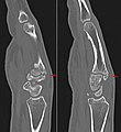 Carpal boss in der Computertomographie: 2 nebeneinander liegende Schichten einer sagittalen MPR.