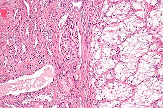 <span class="mw-page-title-main">Renal cell carcinoma</span> Medical condition