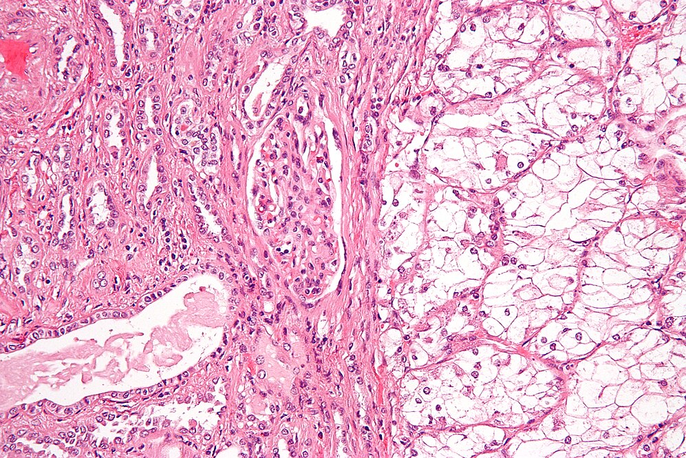 Renal Cell Carcinoma-avatar