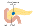 Diagram showing stage T2 cancer of the pancreas CRUK 254-ar.svg