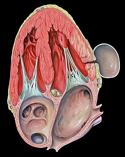 Heart pseudoaneurysm a4c.jpg
