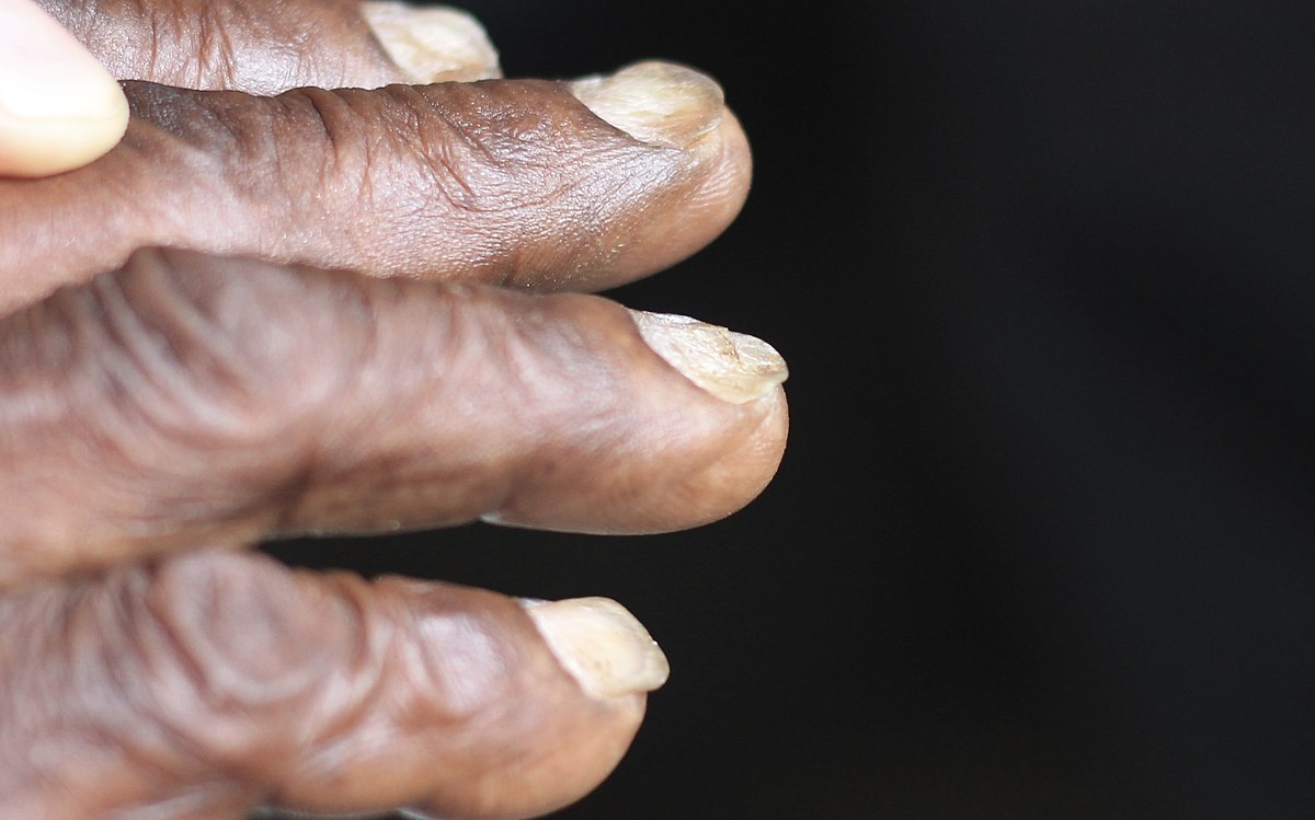 Iron deficiency nail disease hi-res stock photography and images - Alamy