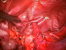 Laparoscopic hernia repair with mesh Lap-HerniaMesh-Sambalis.jpg