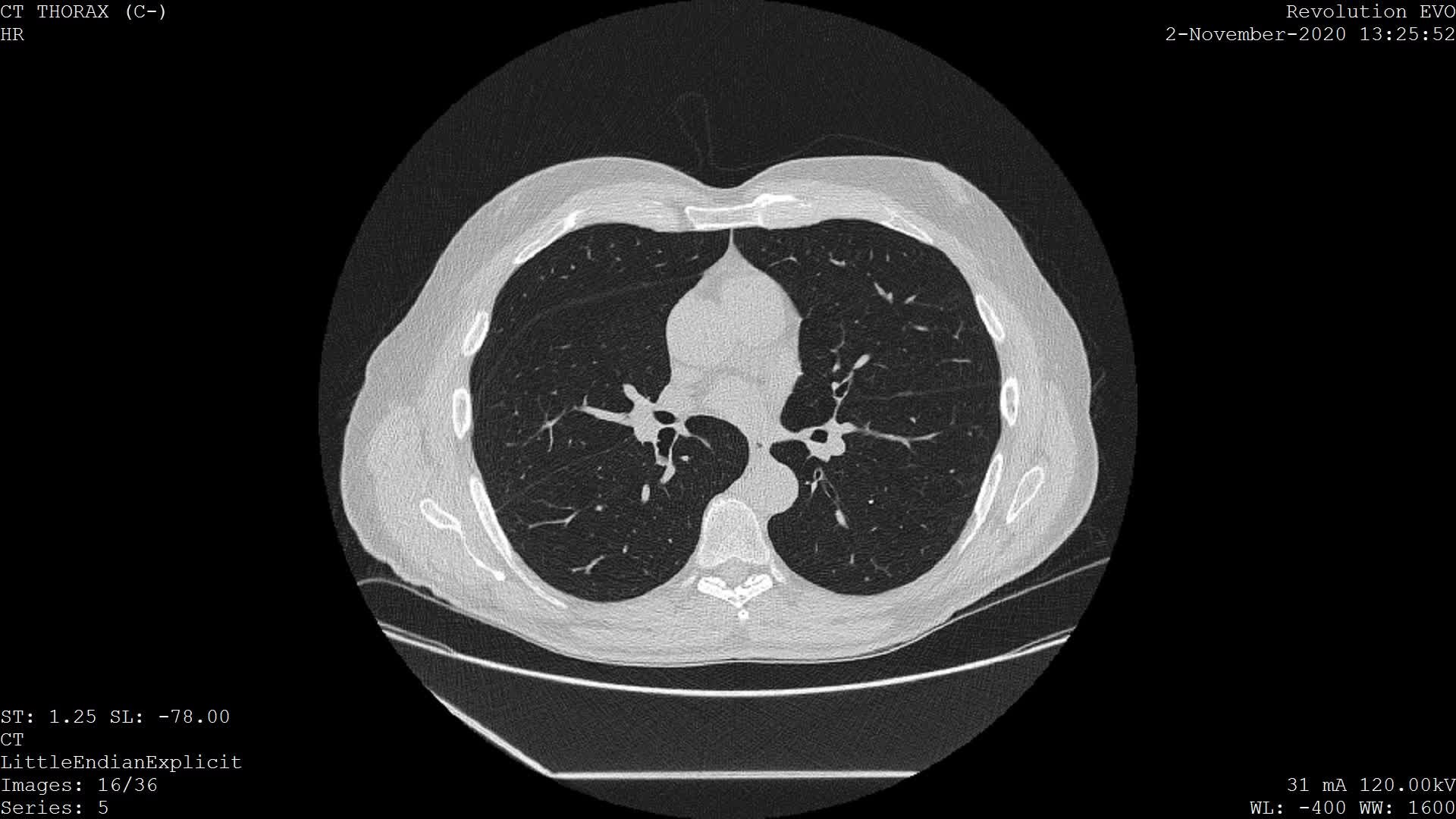 File:Low dose high resolution chest CT (HRCT).ogg - Wikipedia