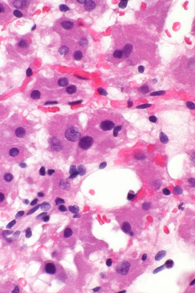 File:Low grade oncocytic renal tumour - alt - very high mag.jpg