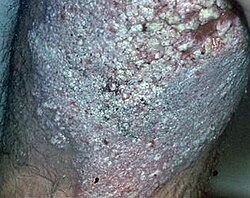 Lupus vulgaris, changes in skin in hyperkeratotic forms