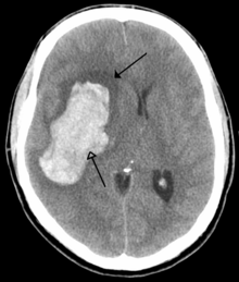 CT scan of an intraparenchymal bleed (bottom arrow) with surrounding edema (top arrow) Parachemableedwithedema.png