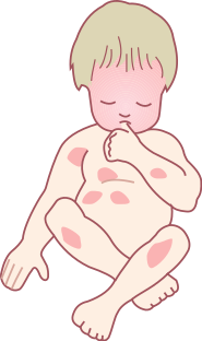 File:Pattern of-Atopic Eczema (Infant).svg