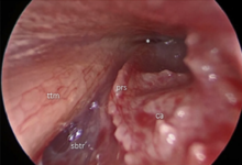 Using 30 degrees endoscope to look into the bony Eustachian tube on a right ear. * indicates opening of the cartilaginous tube. ca: carotid artery. ttm: Tensor Tympani Muscle. prs: Protympanic spine. sbtr: Subtubal Recess. Protympanum.png