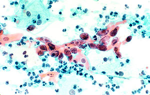 Squamous cell carcinoma in the cervix, pap stain.jpg