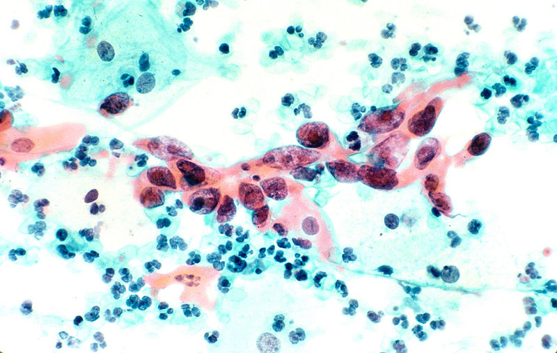 Dosya:Squamous cell carcinoma in the cervix, pap stain.jpg