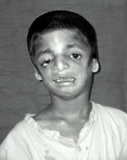 Child with Treacher Collins syndrome