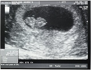 <span class="mw-page-title-main">Crown-rump length</span> Ultrasound measurement of a foetus