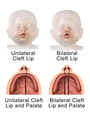 Unilateral and Bilateral Cleft Lip and Palate.png