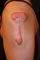 Flat, Superficially Spreading Keloid in Upper Arm Area.