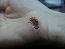 Wound on palm of hand - day 13.jpg