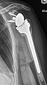 X-ray in anteroposterior view one year after reverse shoulder arthroplasty