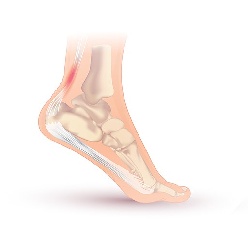 Achilles tendonitis can cause back of ankle pain when you wake up