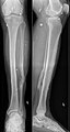Esquirlas de granada en el tejido blando de la pierna (junto a una vieja fractura de la fíbula).