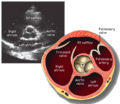 Aortic valve sa.png