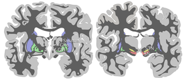 Schematische weergave van een doorsnede van de menselijke hersenen; rood is de substantia nigra, blauw het striatum; geel de nucleus subthalamicus, groen de globus pallidus