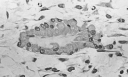 Light micrograph of a nidus consisting of osteoblasts, many are displaying a prominent Golgi apparatus, that have created osteoid at its center. Bony nidus 2.jpg