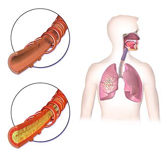 Hemoptysis A medical symptom consisting of bloody mucus from coughing