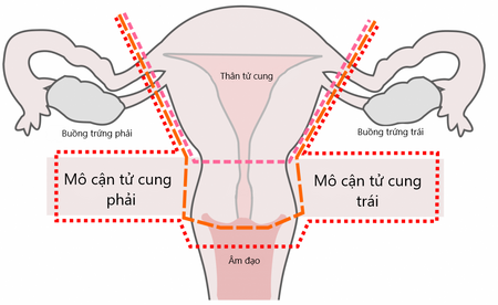 Mô cận tử cung