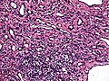 High power view showing a vascular tumor with cuboidal endothelium lining the vessels. Few entrapped seminiferous tubules are also noted (arrow).