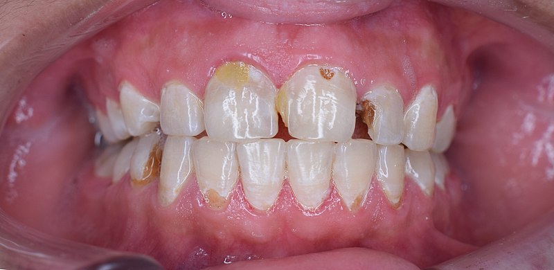 File:Dental decay.jpg