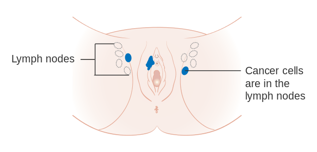 Vulvakrebs mit Leistenlymphknotenbefall
