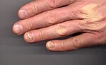 爪甲剥離症のサムネイル