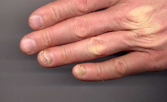 Nails of a COVID‐19 patient 16 weeks after disease diagnosis. The nails...  | Download Scientific Diagram